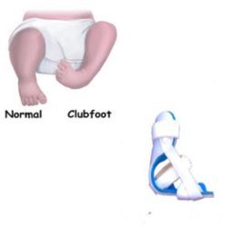Manufacturers Exporters and Wholesale Suppliers of CTEV Splint Surat Gujarat